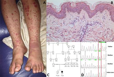 Cutaneous Vasculitis and Recurrent Infection Caused by Deficiency in Complement Factor I